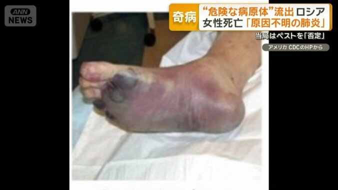 皮膚が黒くなって死亡「黒死病」ペスト