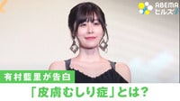 有村藍里が告白した「皮膚むしり症」とは