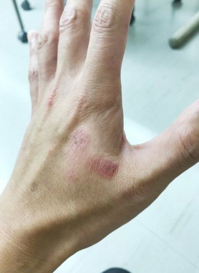 狩野英孝、アトピー性皮膚炎に悩まされていることを告白「辛い」 1枚目