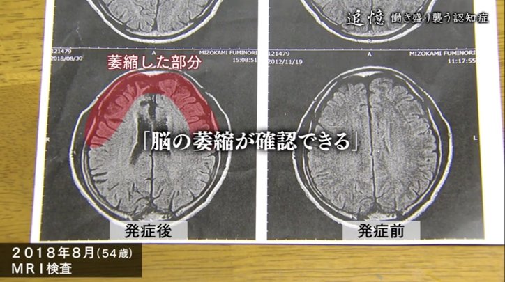 働き盛りで誰もがなりうる「若年性認知症」に… “今まで”が変わっても、希望を持つ家族の“日常”
