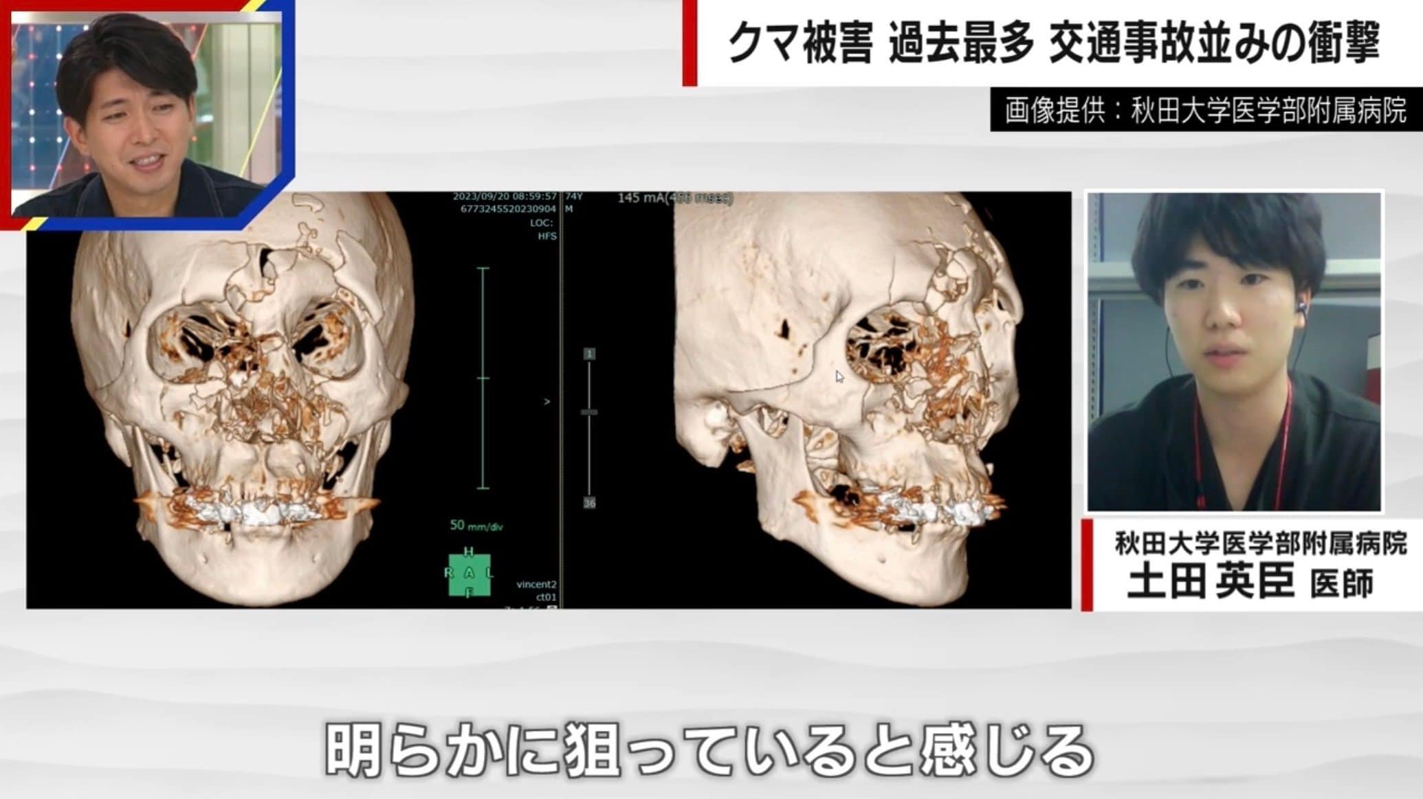 クマが顔面を粉砕…「明らかに狙ってる」「顔面から頭部の外傷が9割」医師が分析 | 国内 | ABEMA TIMES | アベマタイムズ