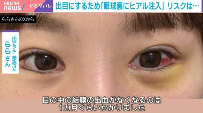 “出目ヒアル”施術を受けたららさん