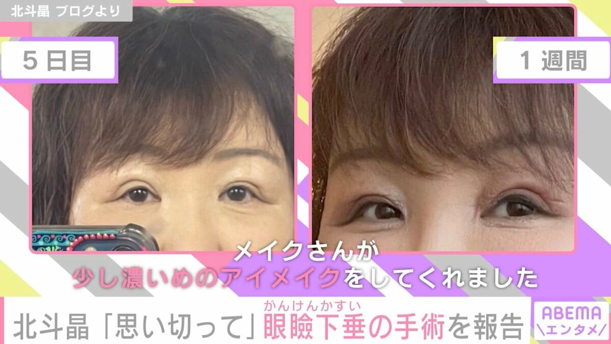 眼瞼下垂 手術 失敗 芸能人
