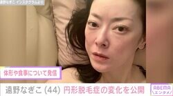 摂食障害を公表・遠野なぎこ、円形脱毛症の変化を告白「グングン成長してない？」