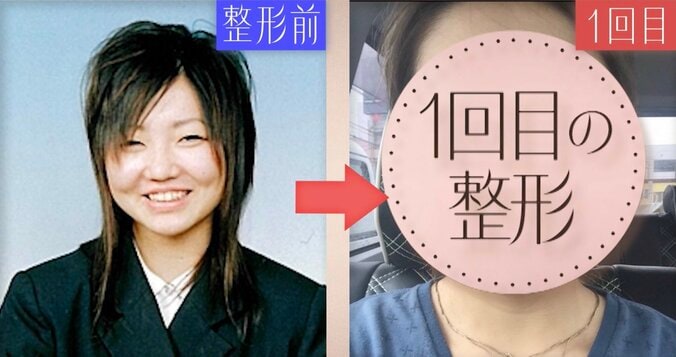 【写真・画像】「整形総額1000万円」19歳から12回繰り返した“顔面課金”の全記録「顔の骨を削り、鼻をフル整形」34歳美女が“お人形フェイス”を手に入れるまで　1枚目