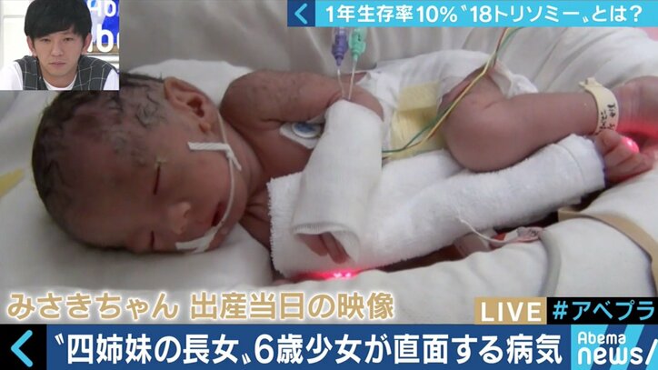 “1年以上の生存率は10％”…18トリソミー児の家族たちが写真展に託した苦悩と葛藤