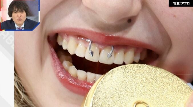 アリサ・リュウ選手の「歯ピアス」（拡大）