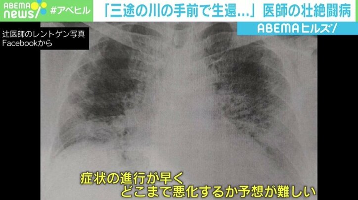 「三途の河の手前で生還」 コロナ感染の医師が語る壮絶闘病「ドクターが『ここでだめだったら死ぬ』と」