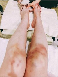 中川翔子「舞台やると必ず」またもや痛々しい脚のアザ公開