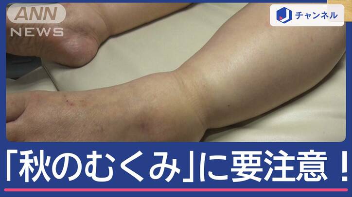 寒暖差で加速「秋のむくみ」対策は？　7割が女性　380万人が症状を訴え