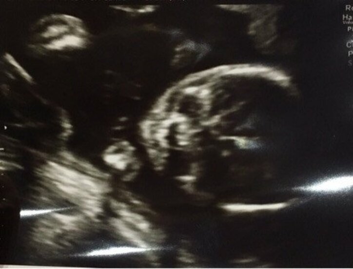 ぺこ、エコー写真を公開　胎動を感じ喜びつづる「にやにやが止まらない」