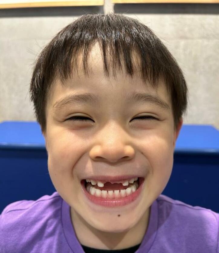  ココリコ・遠藤の妻、麻酔をして過剰歯を抜いた次男の姿を公開「これから約2年は歯っ欠け状態」 