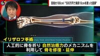 【映像】イリザロフ手術の全容