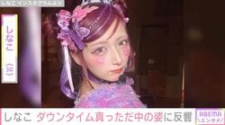 両顎の骨切り手術を受けた しなこ（30）、 ダウンタイム真っただ中の最新ショットを公開