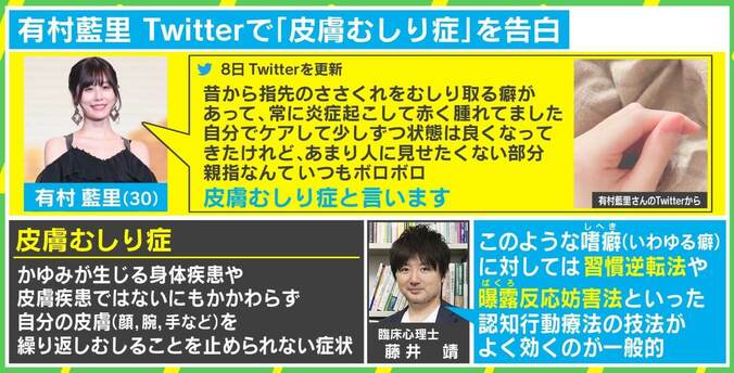 有村藍里も悩む「皮膚むしり症」 6歳で発症した経験者が語る治療“3つのステップ”と専門家による習慣逆転法とは 3枚目