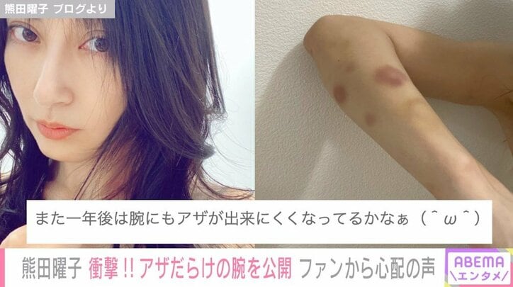 熊田曜子、ポールダンスの練習で右腕を負傷 アザだらけの衝撃写真に「早く消えますように」「体は大切に」と心配の声
